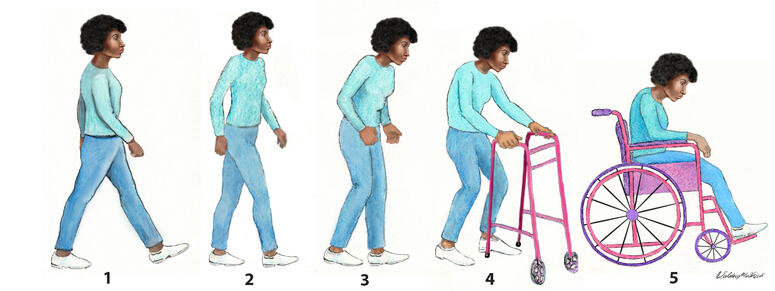 An image depicting the five stages of Parkinson's disease progression in women.