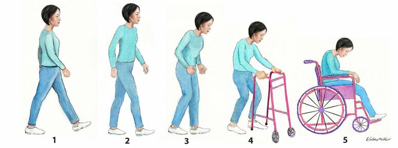 An image depicting the five stages of Parkinson's disease progression in women.