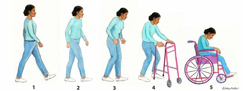An image depicting the five stages of Parkinson's disease progression in women.