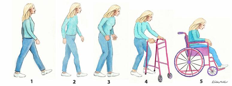 An image depicting the five stages of Parkinson's disease progression in women.