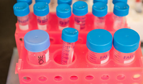 Seizure Medication May Help Movement Symptoms in Lewy Body Dementia
