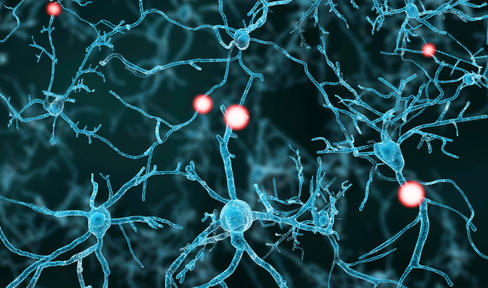 ProSavin Trial Results: Once Again, a Gene Therapy Approach to Parkinson’s Yields Encouraging Safety Data but Modest Efficacy
