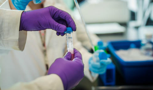 Parkinson's Protein Levels Stable over Year in Early Disease
