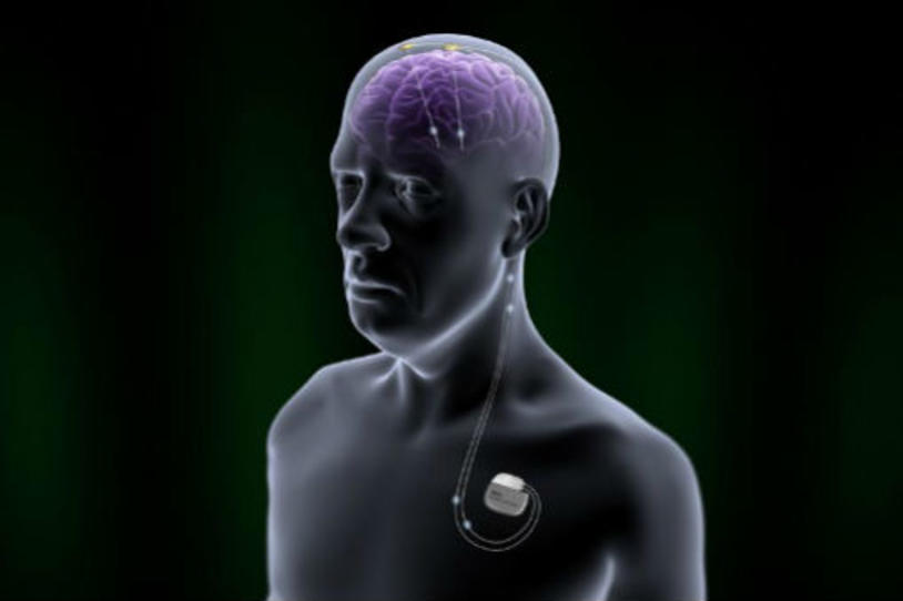 FDA Approves New Deep Brain Stimulation Device