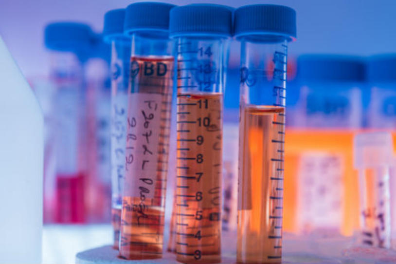 News in Context: Cancer Drug to Reverse Parkinson’s Symptoms