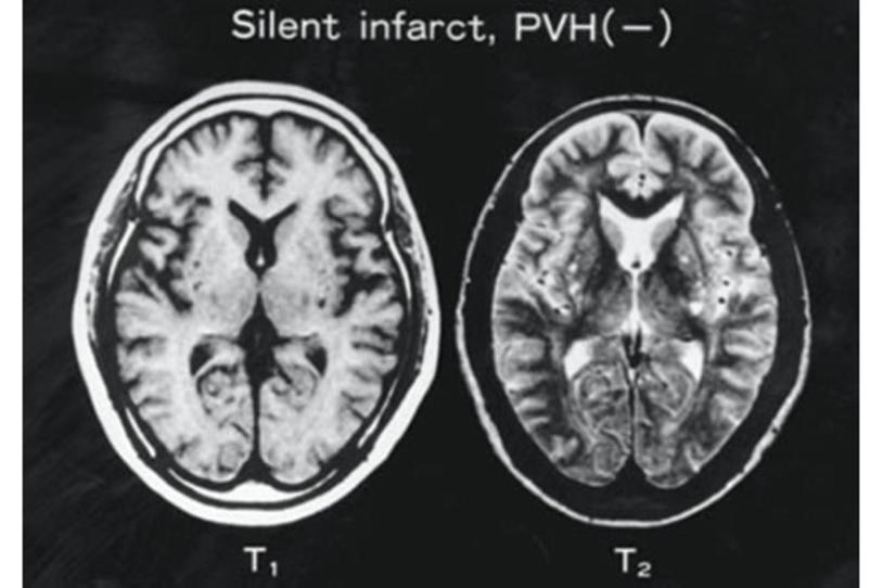 Could ‘Silent Strokes’ Cause Parkinson’s Disease?