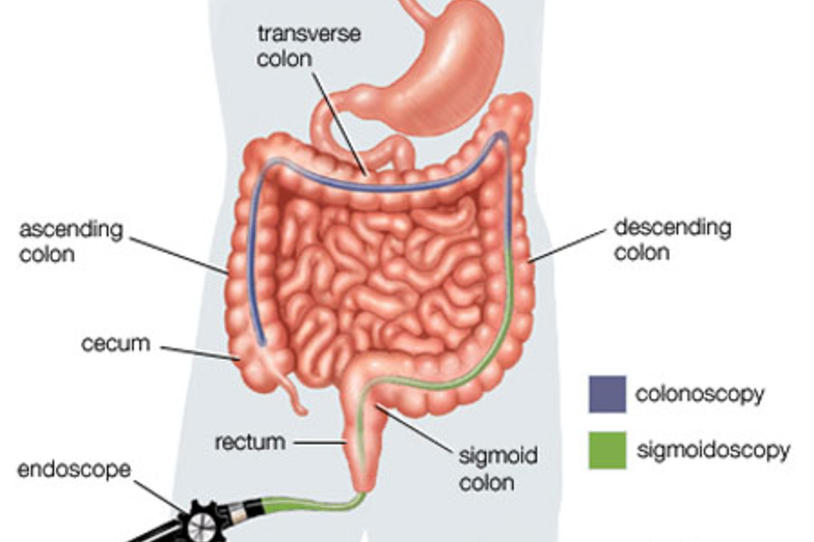 Scoping Out Early Parkinson’s: Can Colonoscopies Predict PD?