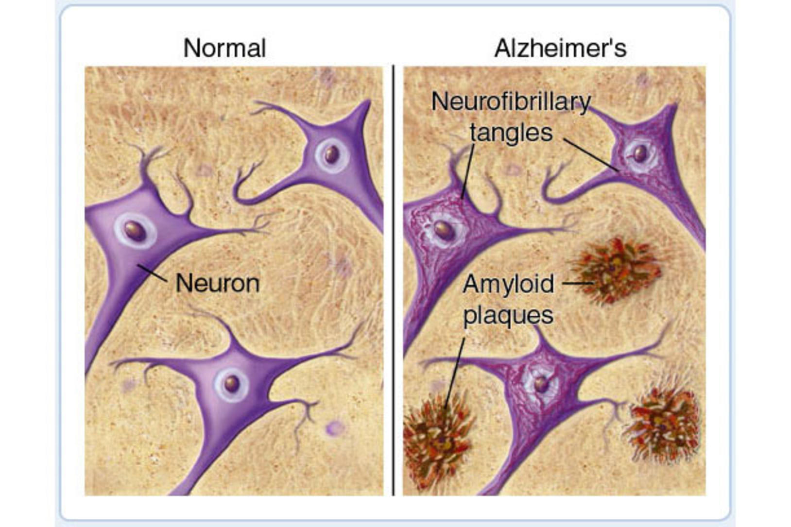 Resurrecting Tau in the Search for an Alzheimer’s (and Potentially ...