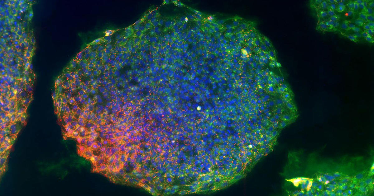 iPS Cells Show Individualized Response to Parkinson’s Disease ...