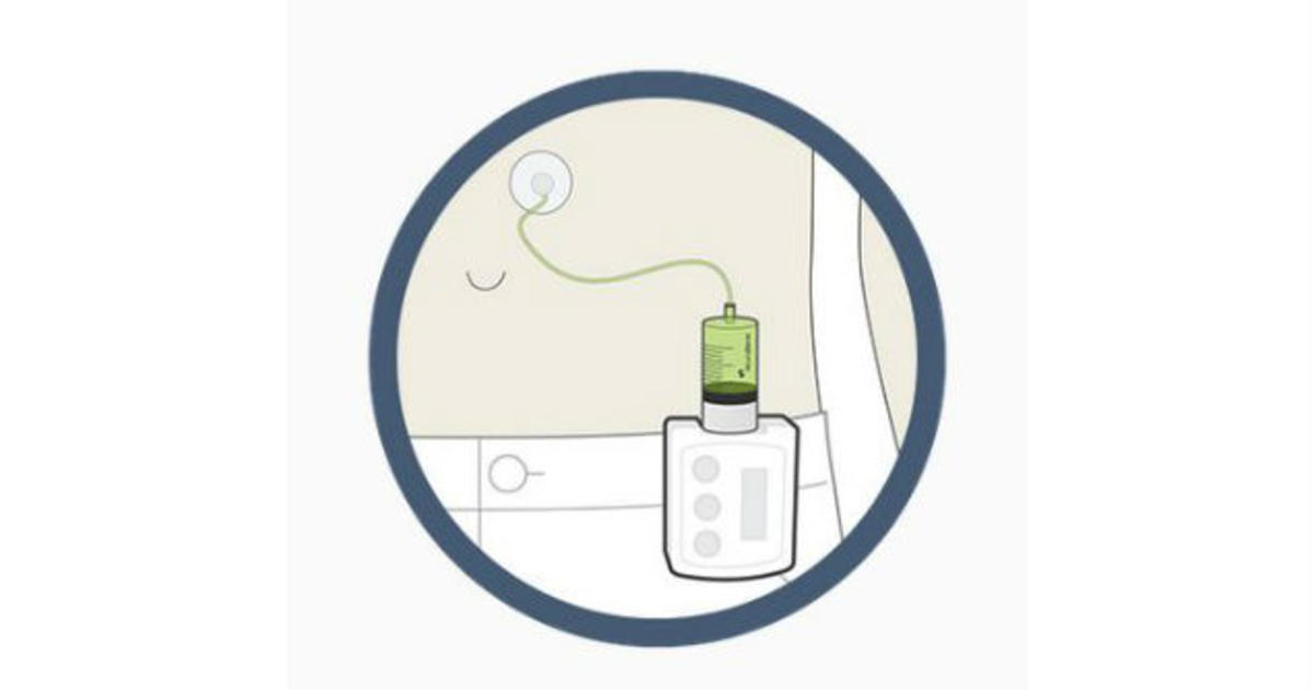 Levodopa Pump Shows Promising Phase II Results | Parkinson's Disease